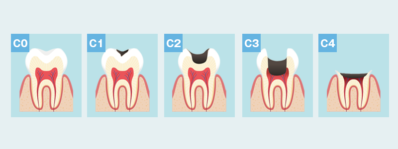 南大沢の歯医者、サンライズ歯科の虫歯の進行を説明するイラスト