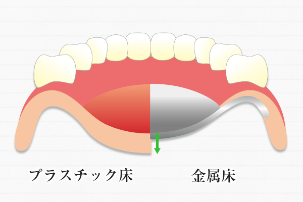 南大沢の歯医者、サンライズ歯科の入れ歯比較のイラスト図。プレスチック床と金属床の比較。