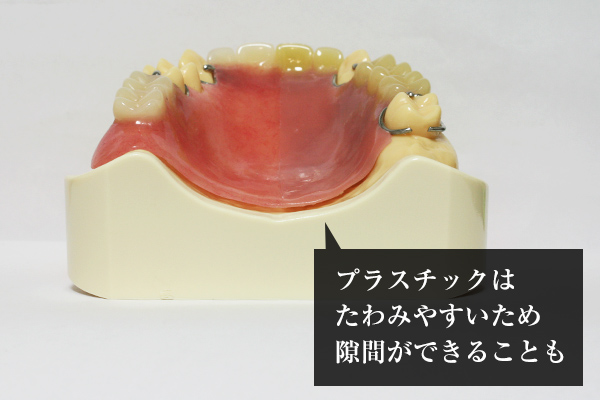 南大沢の歯医者、サンライズ歯科の入れ歯の模型写真
