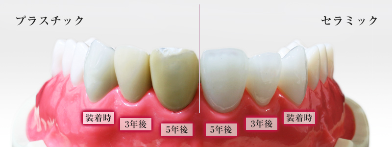 南大沢の歯医者、サンライズ歯科の前歯のかぶせもの、保険治療と自費治療の比較写真