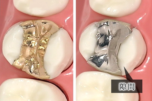 南大沢の歯医者、サンライズ歯科の銀歯と金歯の精度の違いを説明する比較写真