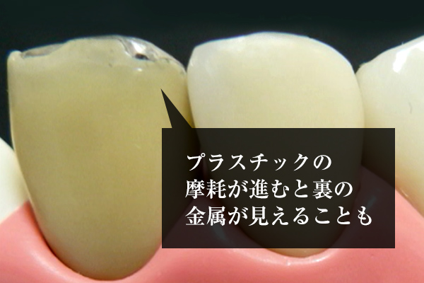 南大沢の歯医者、サンライズ歯科の耐久性を説明する、前歯の比較写真。保険治療と自費治療の比較。