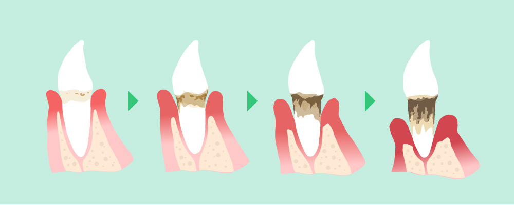 南大沢の歯医者、サンライズ歯科の歯周病進行段階についての説明図